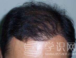 种植头发的费用